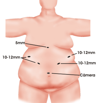 Laparotomia e Laparoscopia